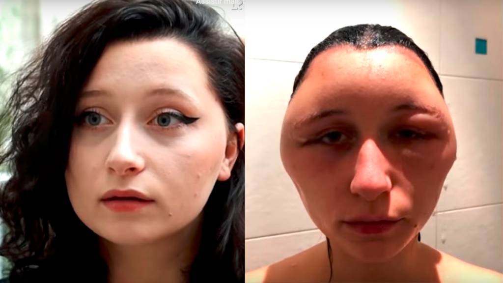 Cabeça de jovem dobra de tamanho após reação alérgica a tintura