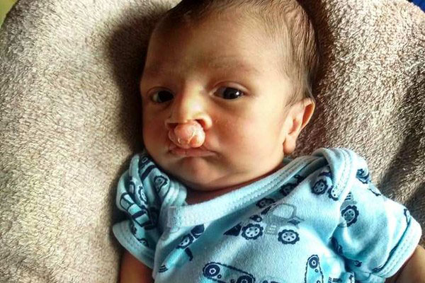 Bebê nasce com o céu da boca para fora e gera onda de solidariedade