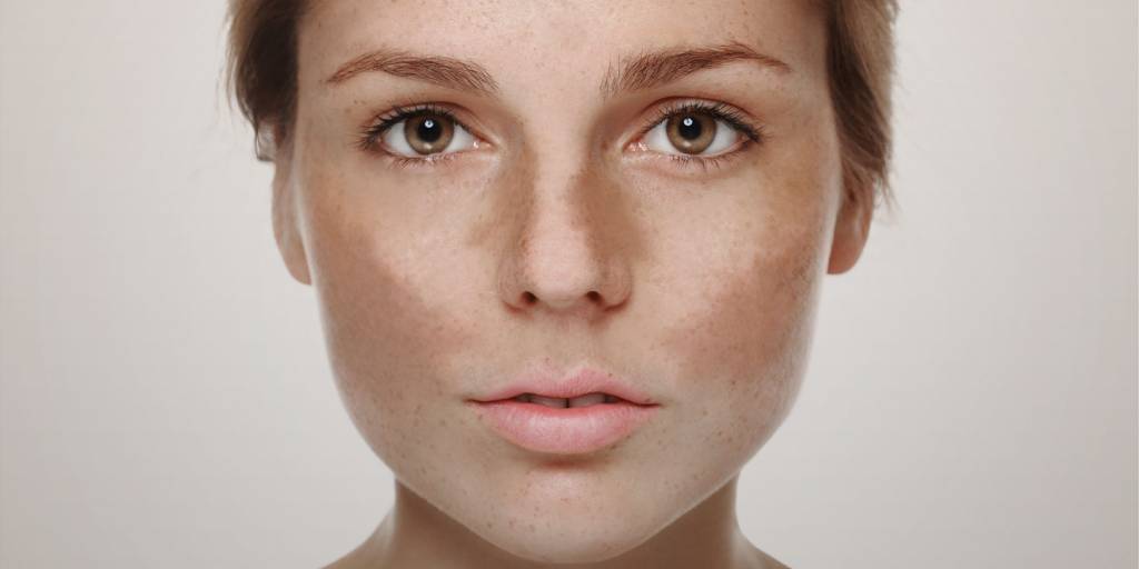 Novidades sobre o melasma