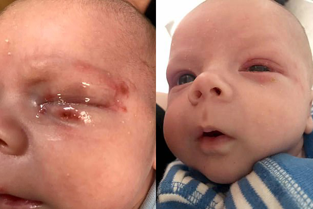 Noah Tindle, bebê que teve herpes no olho