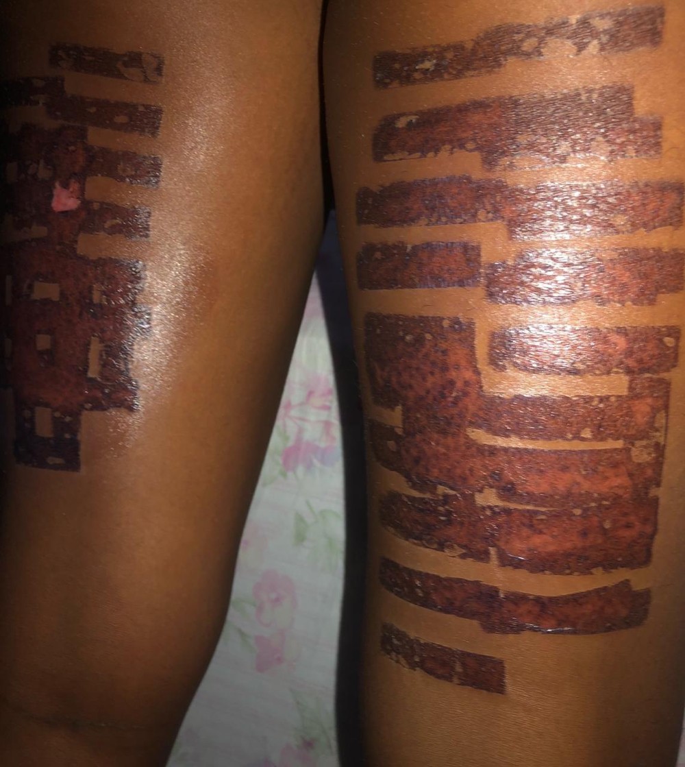 Modelo sofre queimaduras de 2º grau durante procedimento estético