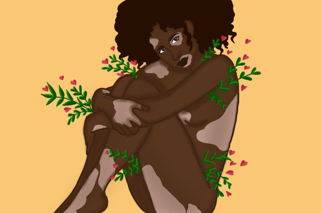 Três mulheres contam como aprenderam a aceitar e conviver com o vitiligo
