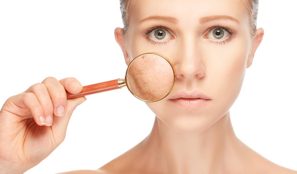 Mitos e verdades sobre o melasma