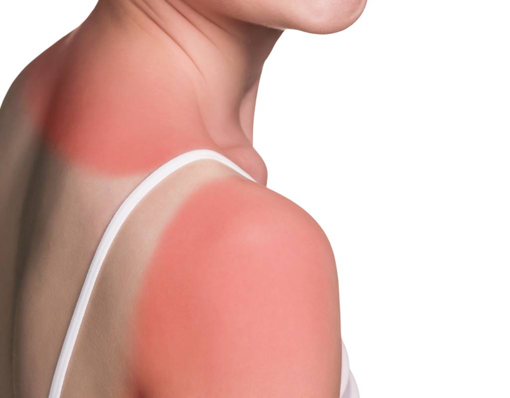 Sunburn female shoulder