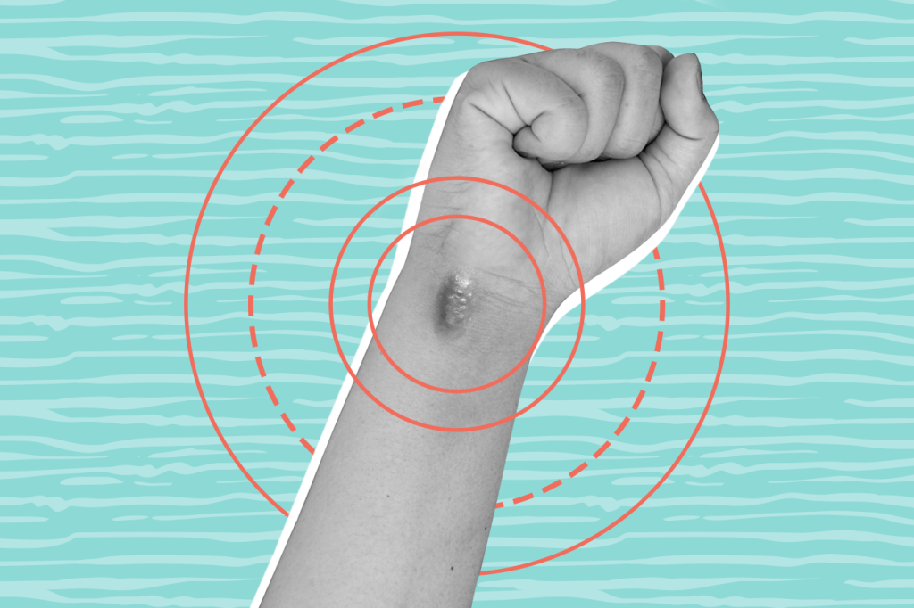 Queloide: tudo o que você precisa saber sobre o assunto