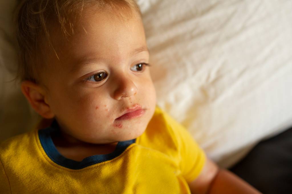 “Fiquei assustada”: casos da doença mão-pé-boca crescem em crianças