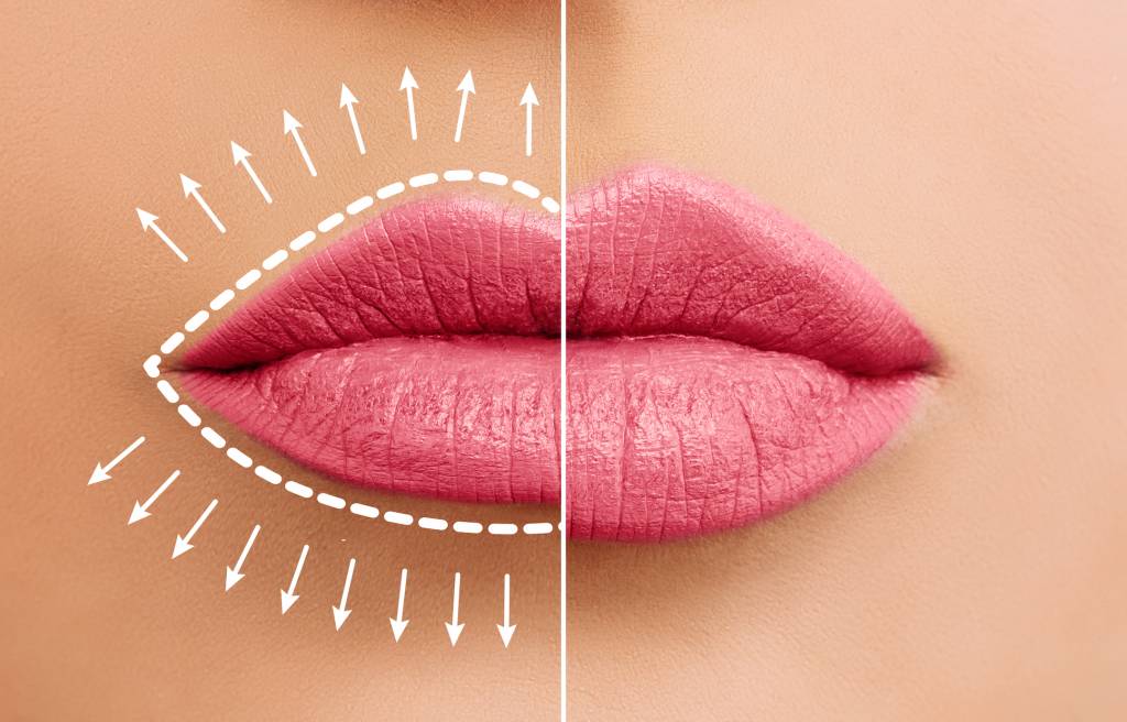 6 mitos e verdades sobre o preenchimento labial