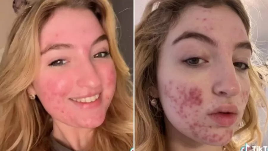 Jovem tem conta do TikTok cancelada por conta de manchas de acne