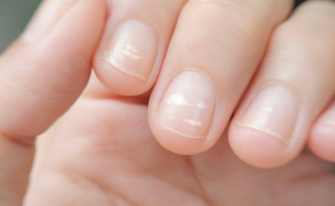 manchas brancas nas unhas o que são