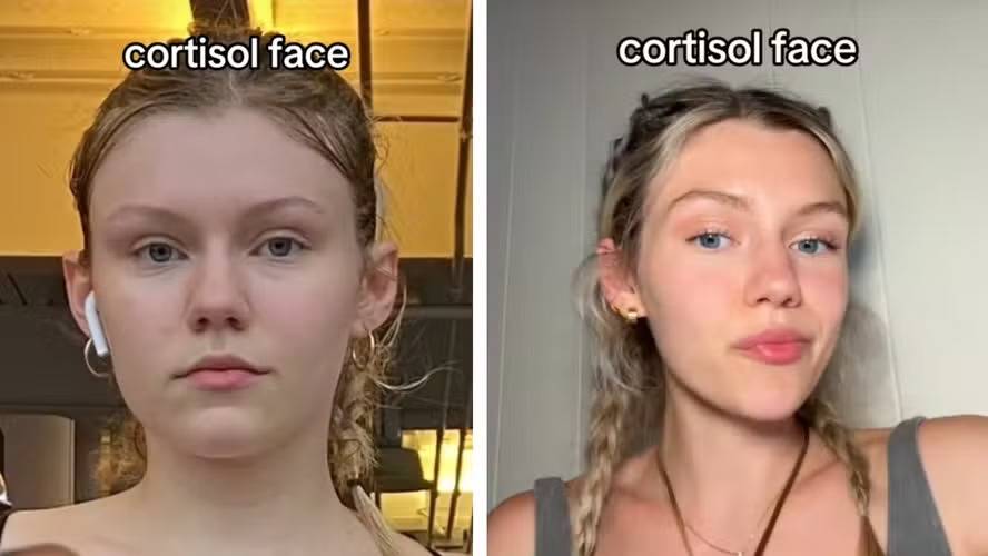 ‘Cortisol face’: hormônio do estresse pode transformar o rosto?