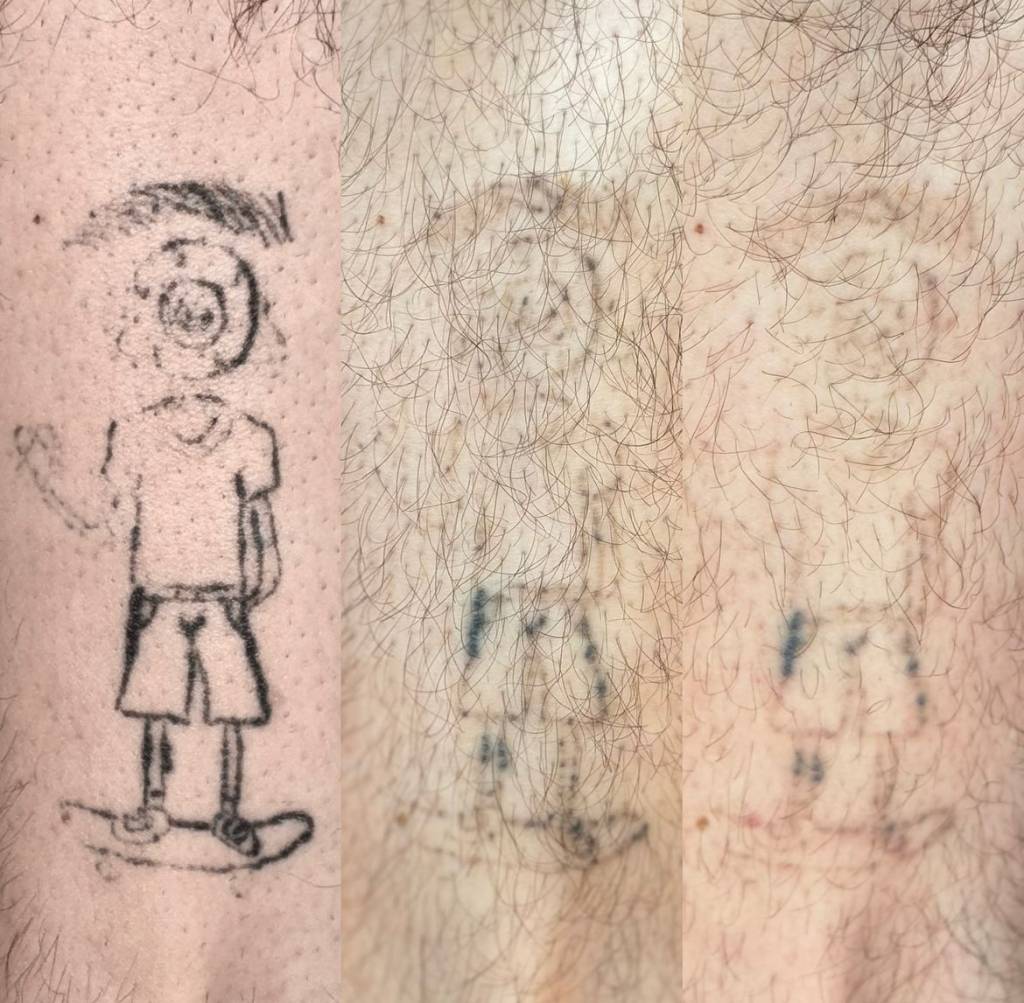 A remoção de tatuagem é altamente eficaz