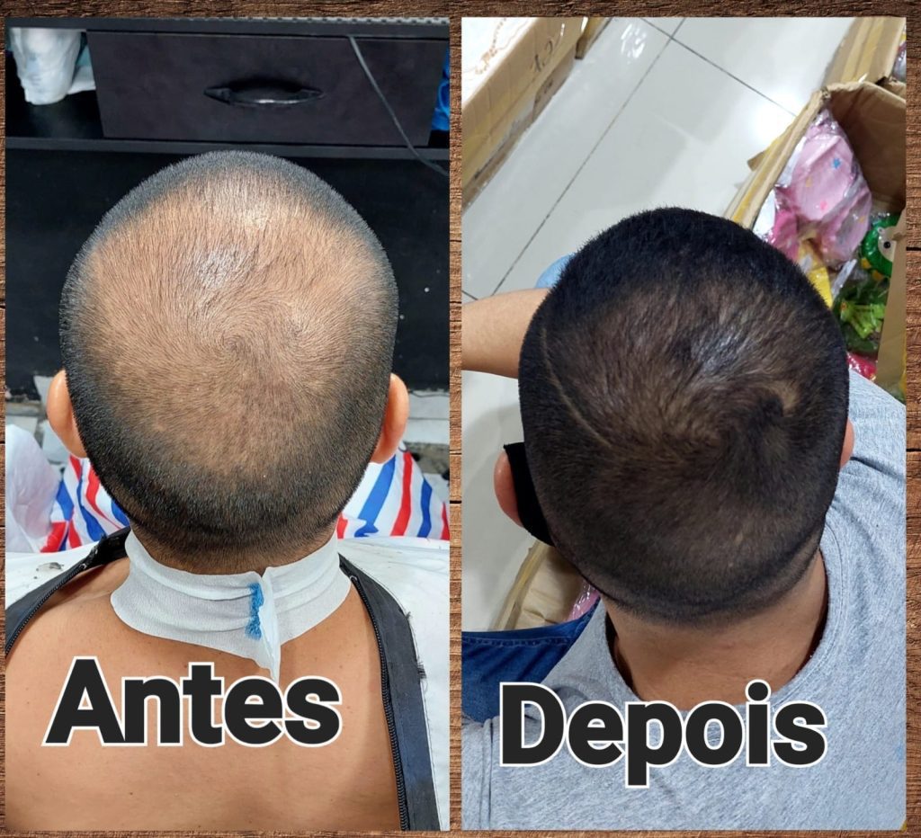 minoxidil-antes-e-depois-2 Antes e depois do Minoxidil.