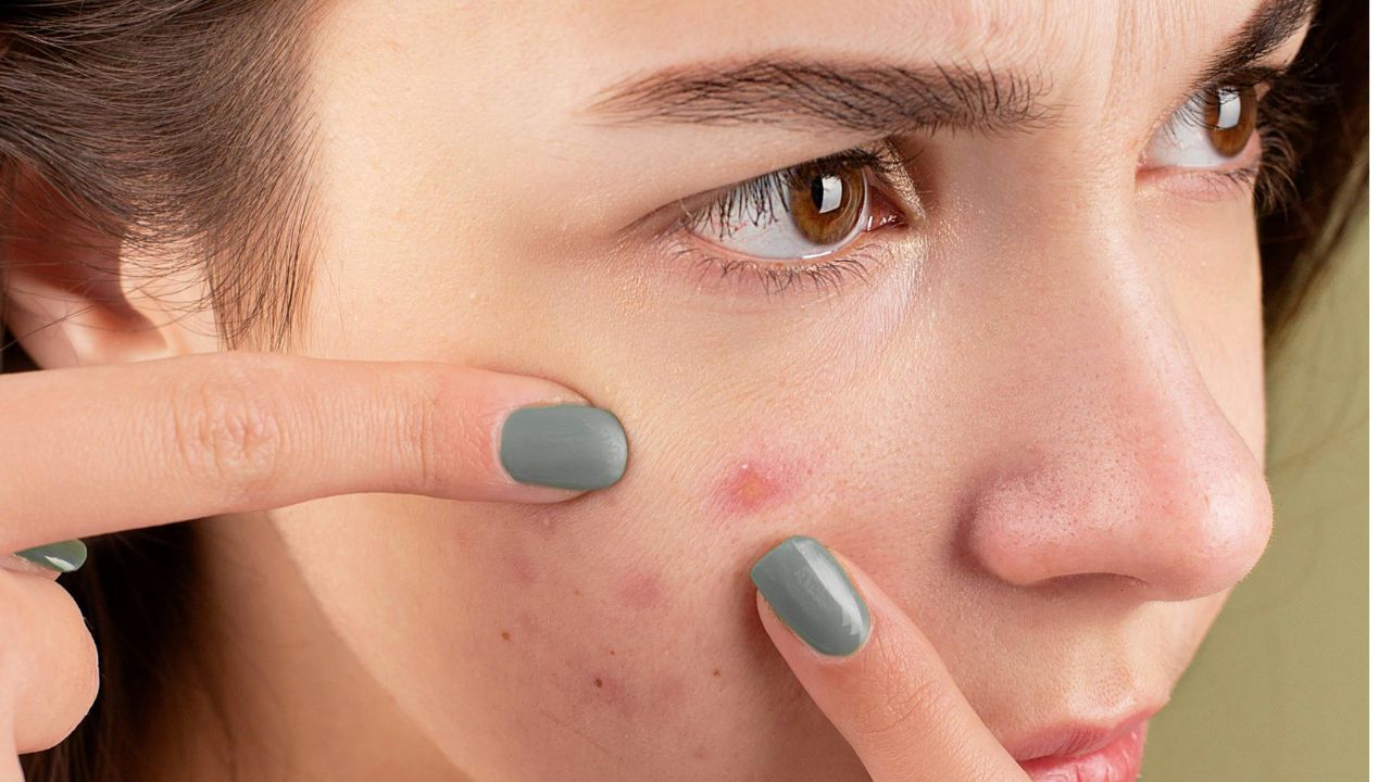 Mulher branca com espinhas no rosto