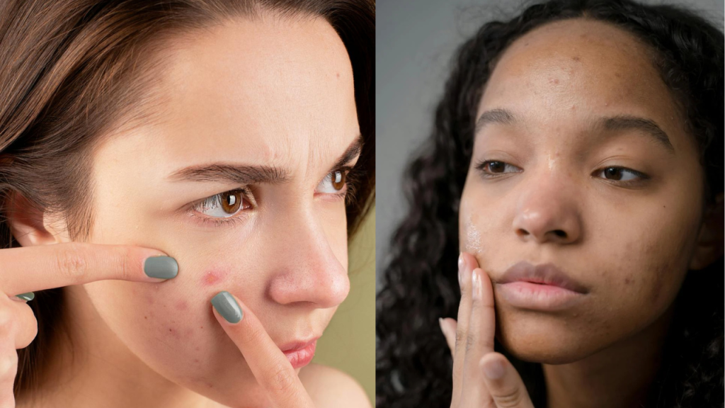 açucar-é-responsável-pela-inflamação-da-pele O açúcar é um dos grandes responsáveis pela inflamação da pele