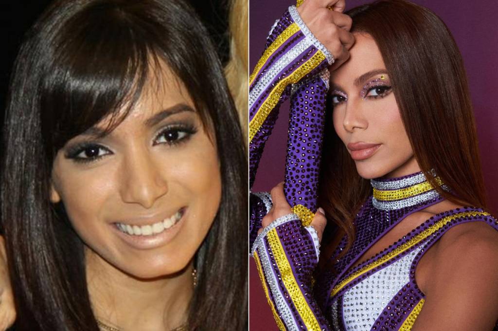 rinoplastia-antes-depois-anitta (1) Anitta antes da rinoplastia e atualmente
