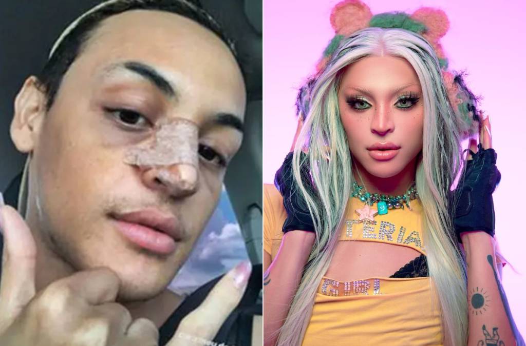 rinoplastia-antes-depois-pabllo-vittar (1) Pabllo Vittar mostrou como estava seu nariz logo após a rinoplastia