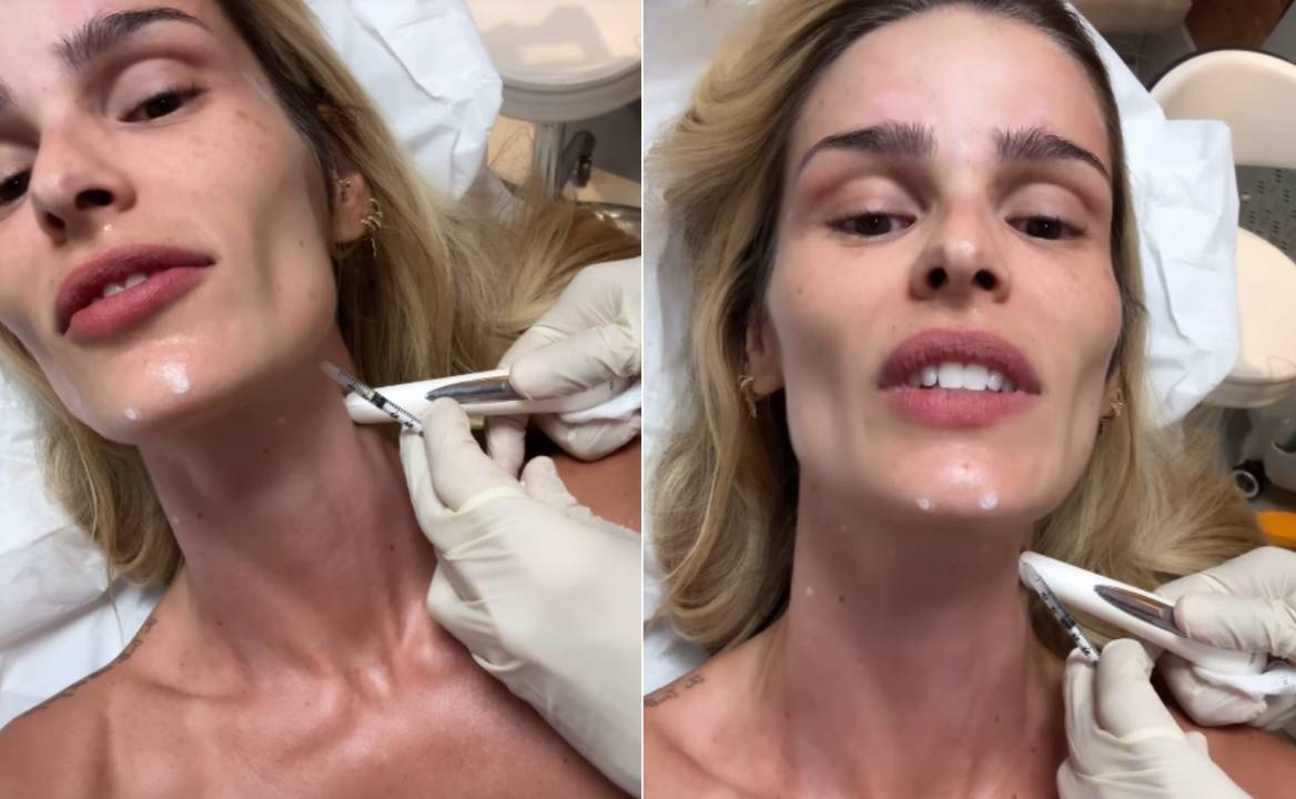 Yasmin Brunet compartilhou nos stories como é a aplicação do botox nefertiti
