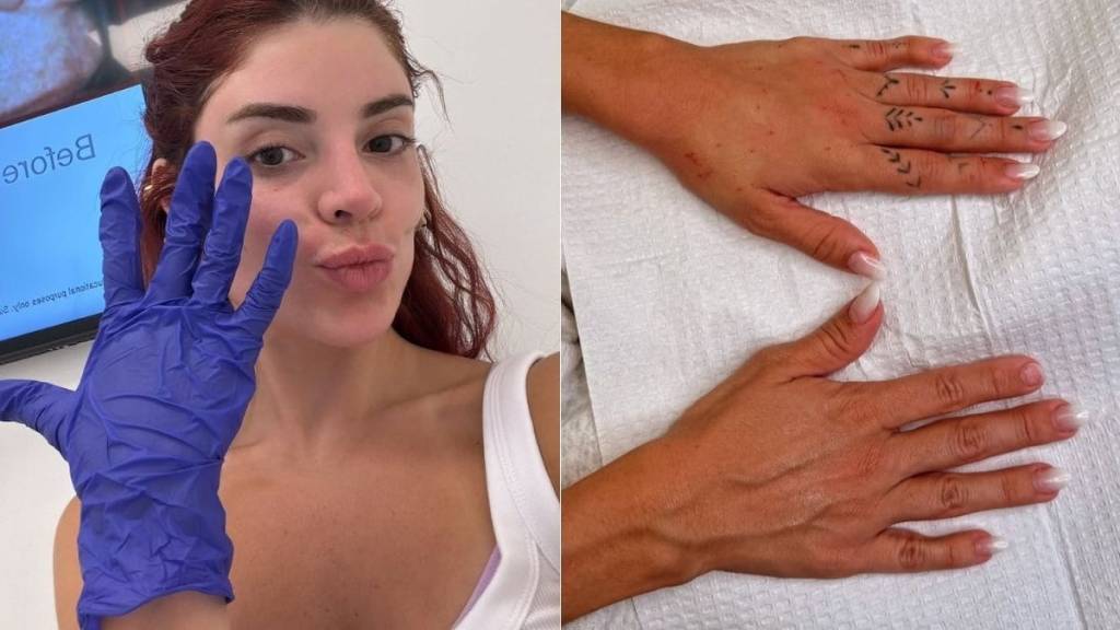 Gkay realiza “harmonização da mão”: o que é o procedimento?