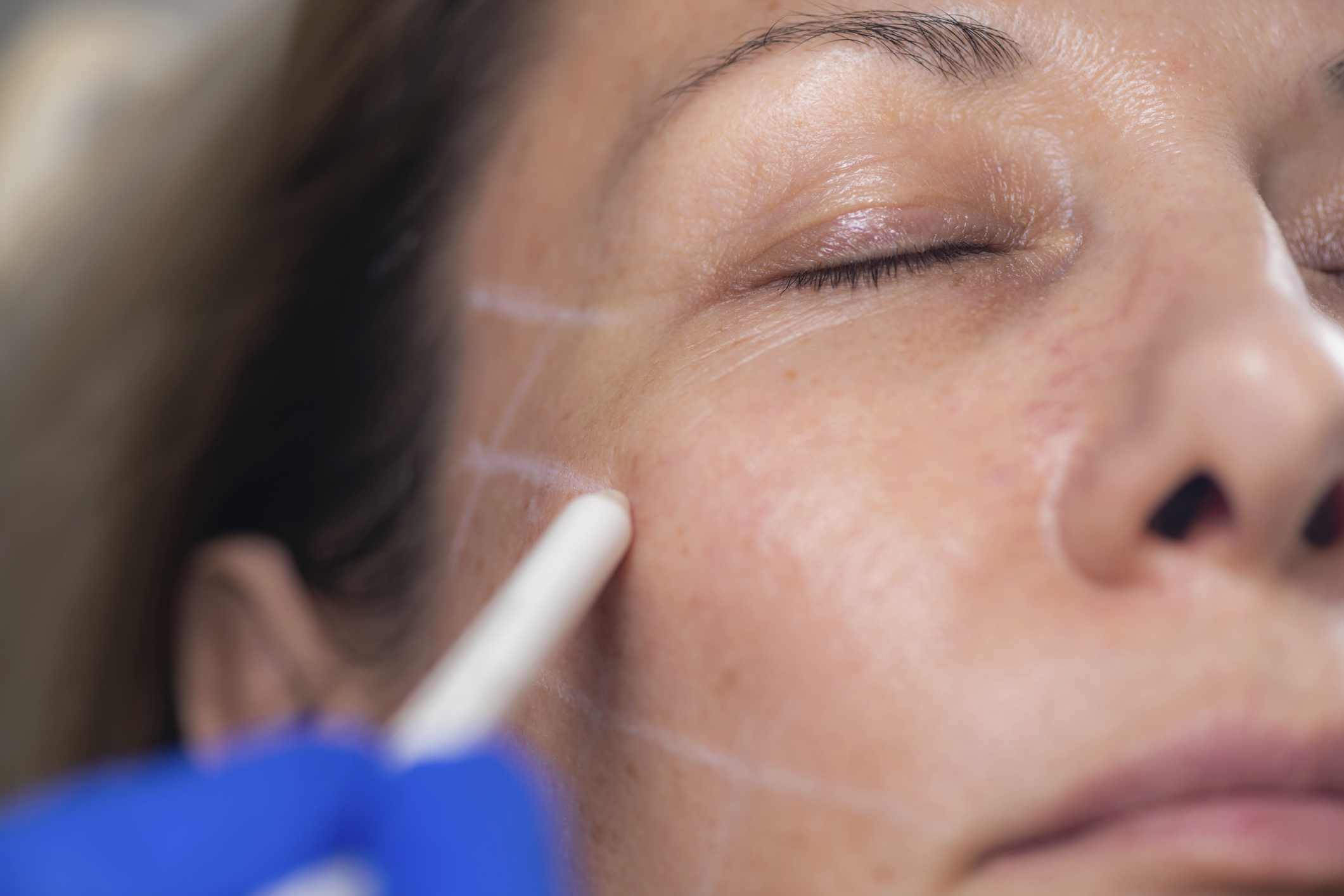 lifting-facial-sem-bisturi