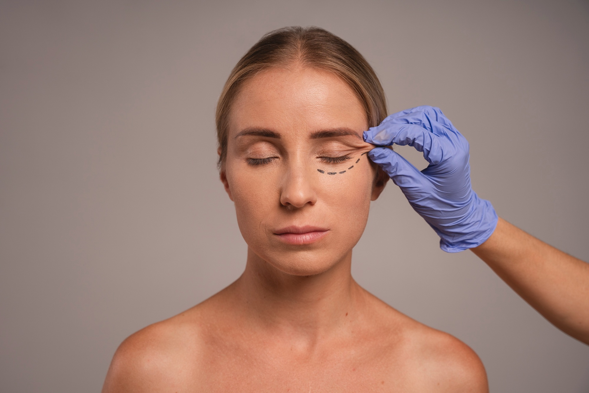Outra mulher &eacute; mostrada com marca&ccedil;&otilde;es abaixo dos olhos enquanto uma m&atilde;o com luva m&eacute;dica toca a regi&atilde;o, simulando o planejamento de um procedimento est&eacute;tico voltado para a &aacute;rea das olheiras.