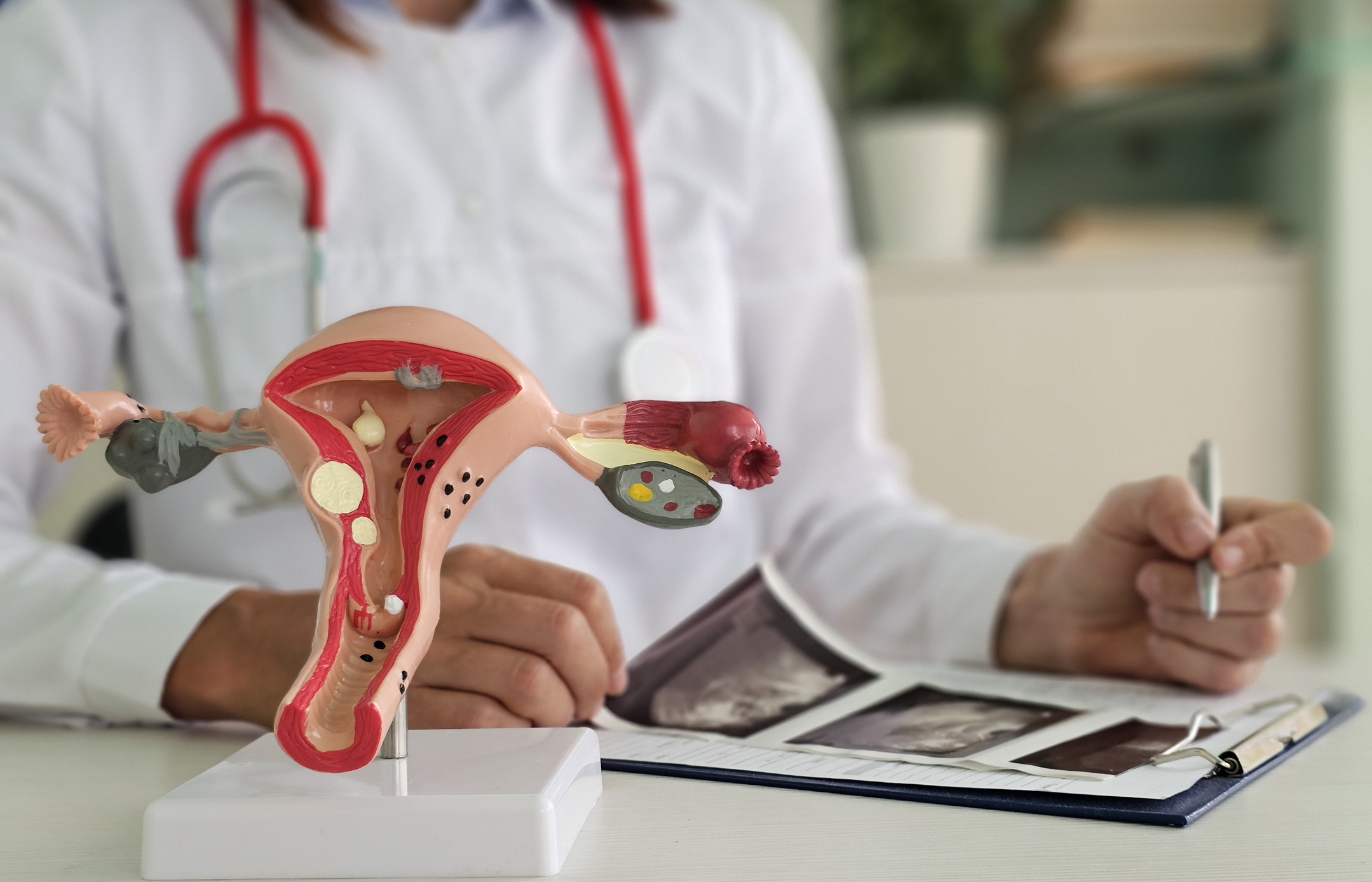 Modelo anatômico do sistema reprodutor feminino em primeiro plano, com útero, ovários e trompas de Falópio. Ao fundo, um médico de jaleco branco e estetoscópio vermelho no pescoço segura uma caneta, com exames de ultrassom sobre uma prancheta na mesa